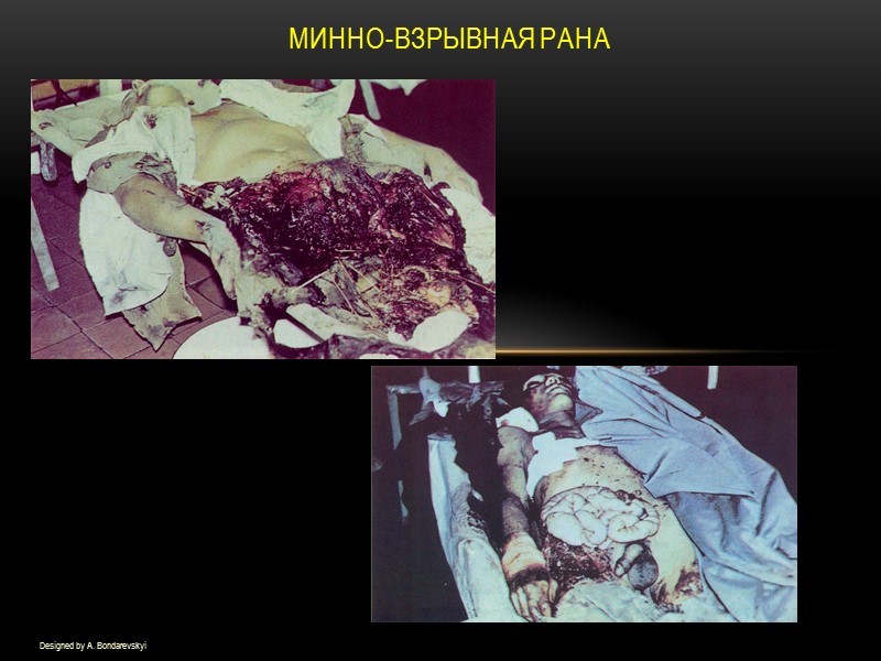 Минно-взрывная рана Designed by A. Bondarevskyi